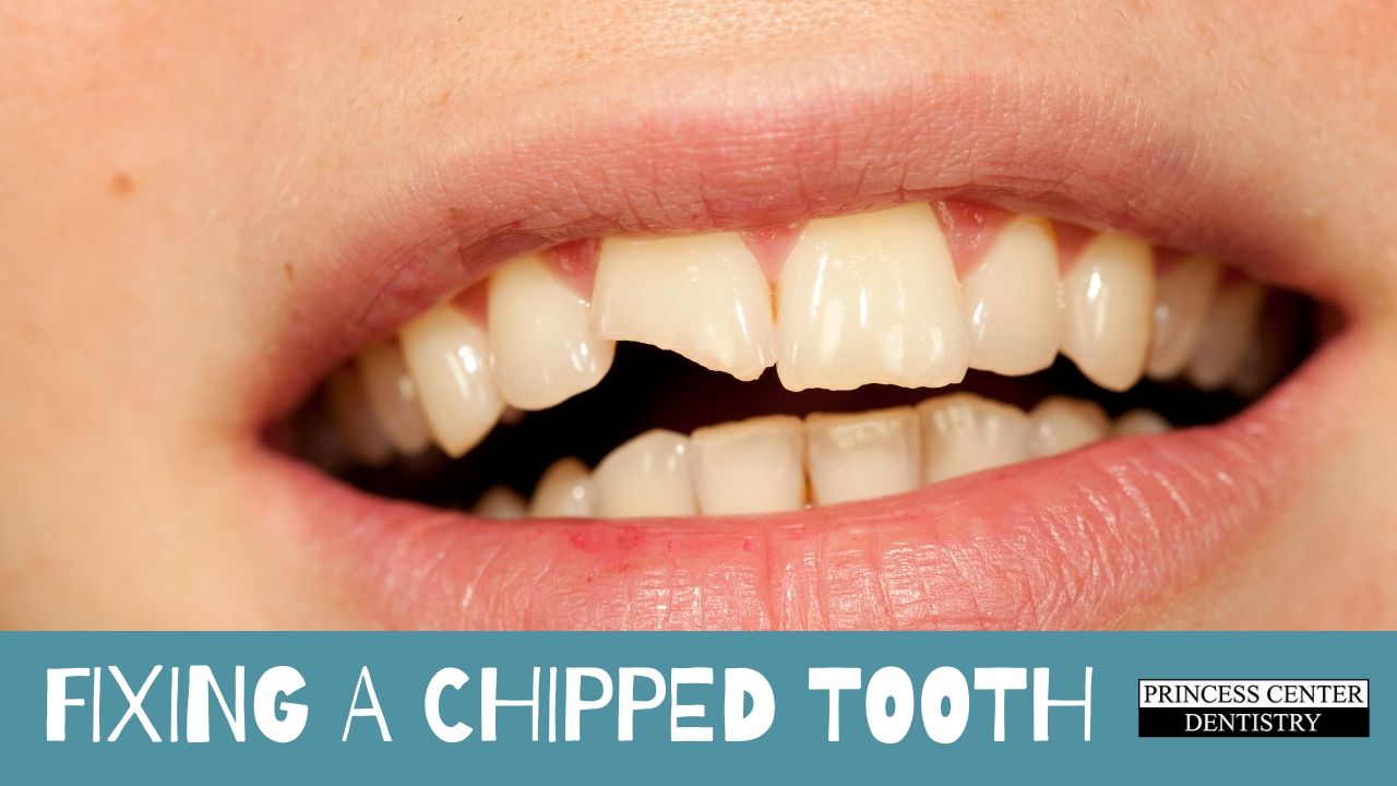 A chipped tooth