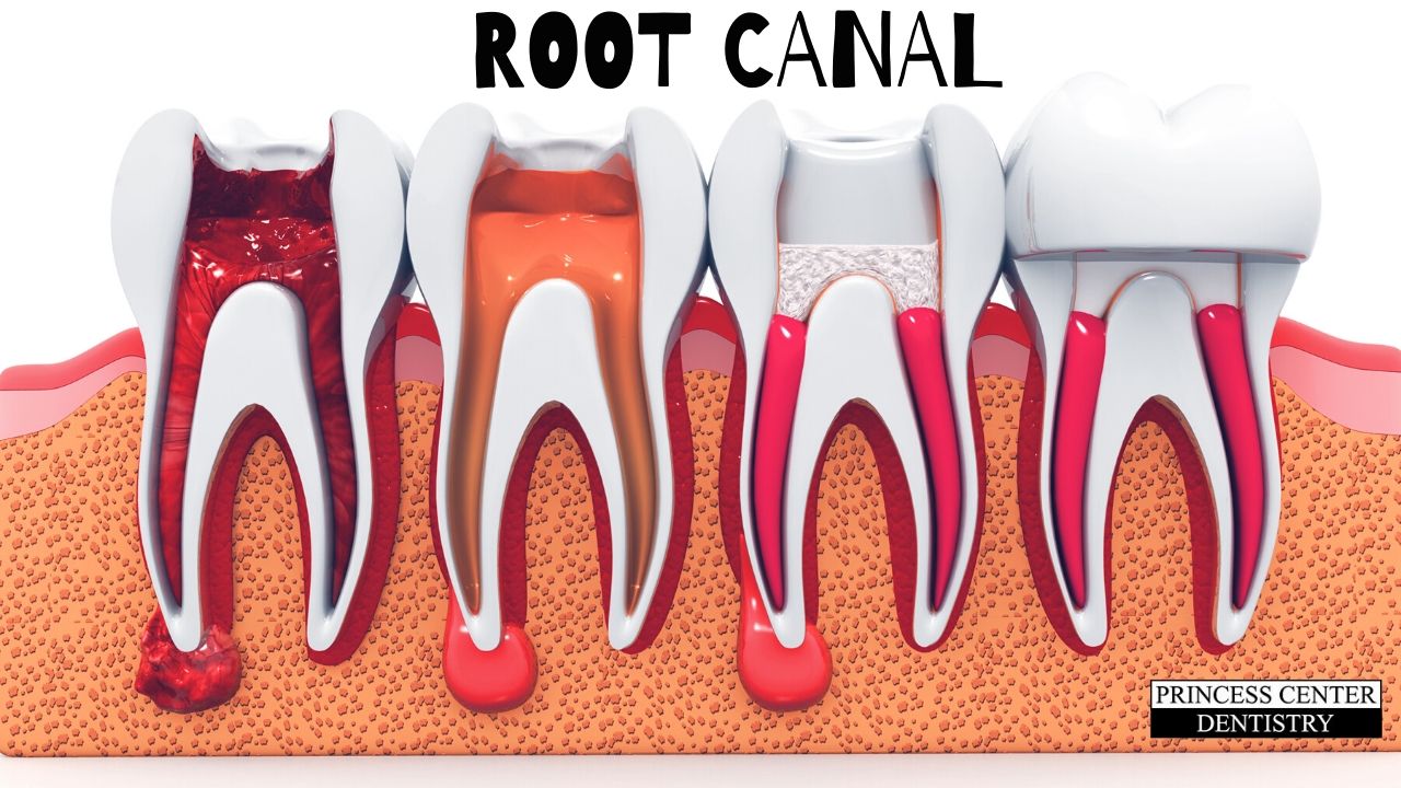 Teeth and roots