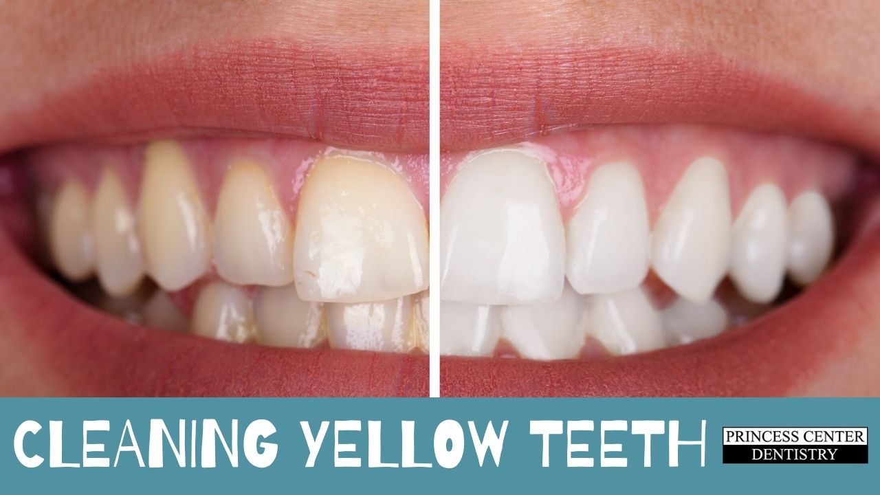 Comparison of yellow teeth and white teeth