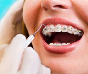 Woman gets her braces fixed