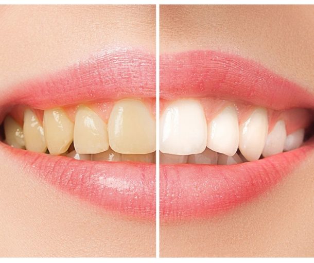 Teeth Whitening Princess Center Dentistry Scottsdale Az