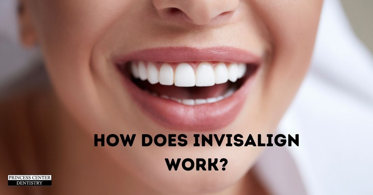 How Does Invisalign Work? - Princess Center Dentistry